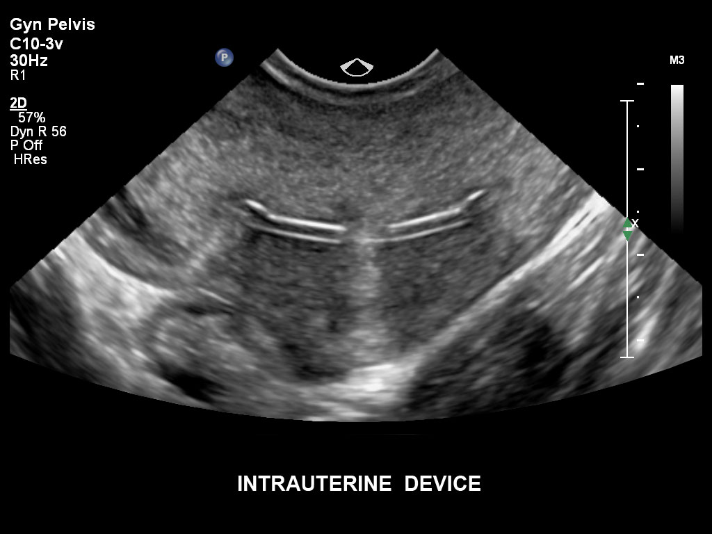 pregnancy ultrasound baby