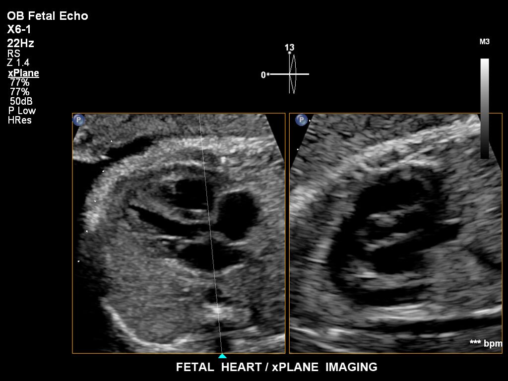 pregnancy ultrasound baby