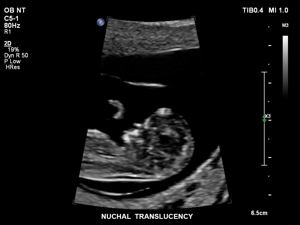 pregnancy ultrasound baby