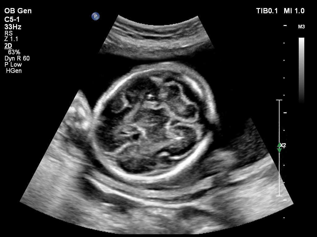 pregnancy ultrasound baby