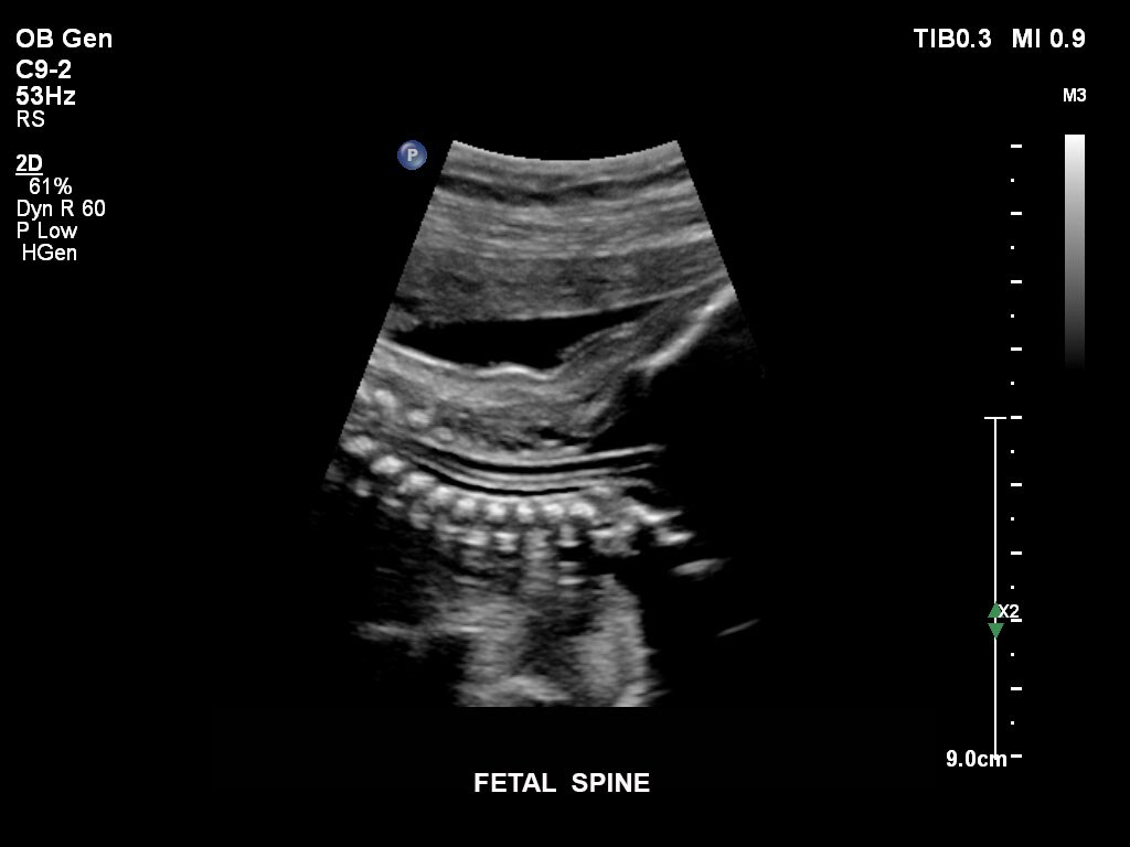 pregnancy ultrasound baby