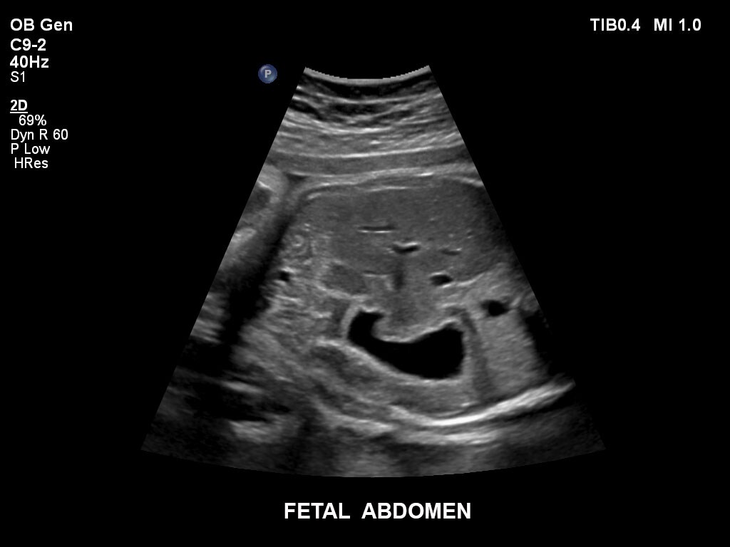 pregnancy ultrasound baby