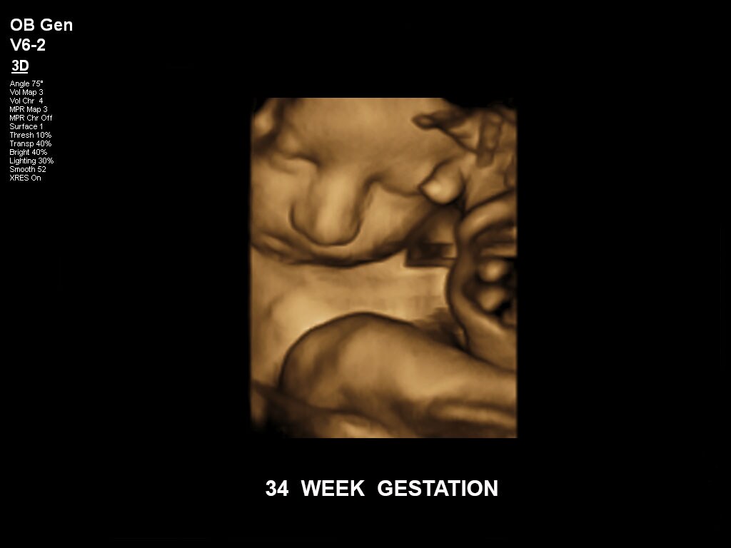 pregnancy ultrasound baby