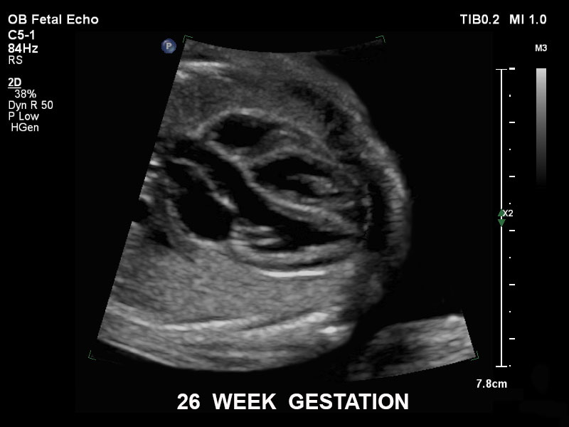 pregnancy ultrasound baby