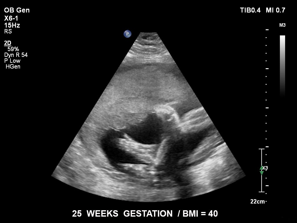 pregnancy ultrasound baby