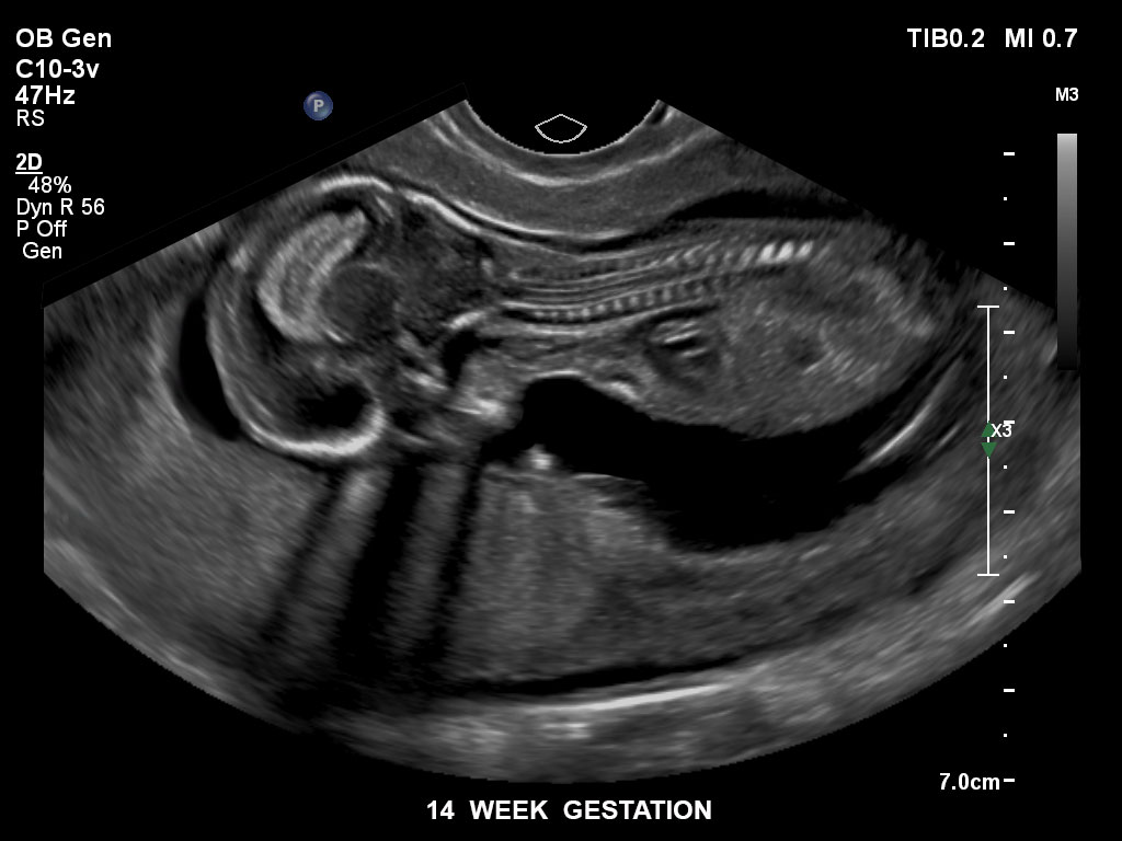 pregnancy ultrasound baby