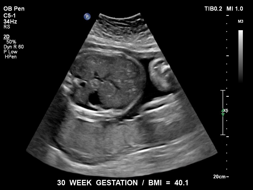 pregnancy ultrasound baby