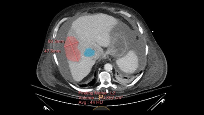 spectral tumor tracking thumbnail