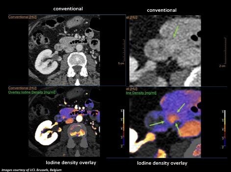 Spectral CT