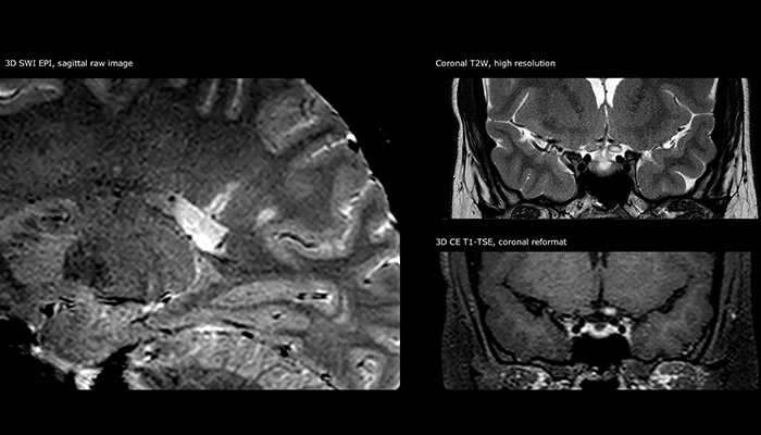 clinical image multiple sclerosis day 3