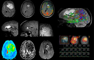 Left frontal glioblastoma multiforme