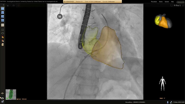 Echo navigator heart segmentation