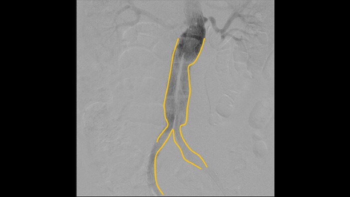 Outlining tool for marking bifurcations or side branches