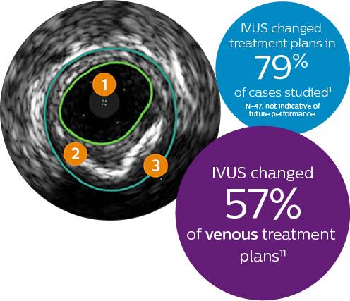 IVUS changed treatment