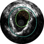 Thrombus image